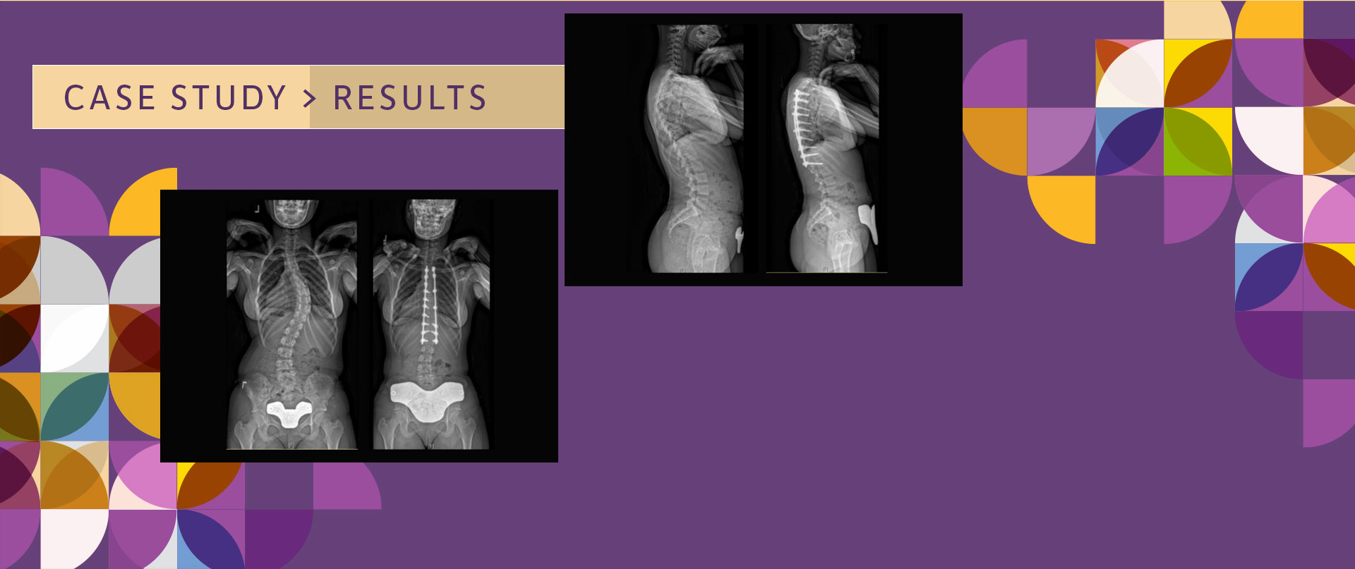 scoliosis case study - results