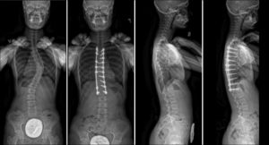 Commonly-Performed-Scoliosis-Surgeries-1AN
