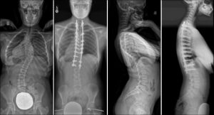 Commonly-Performed-Scoliosis-Surgeries-1B