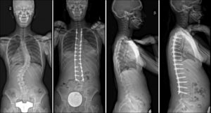 Commonly-Performed-Scoliosis-Surgeries-1CN