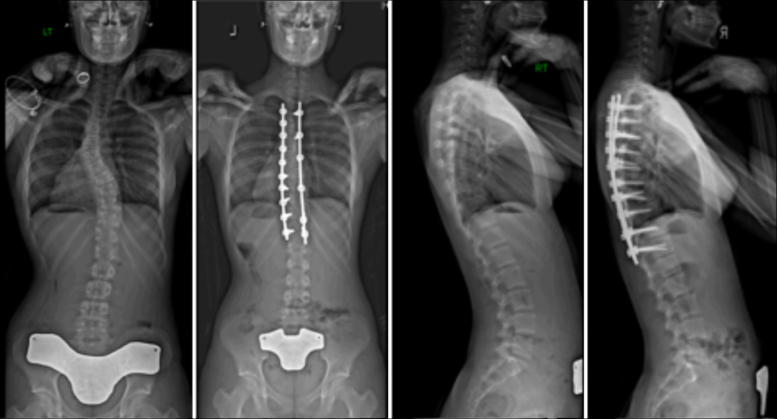 Commonly Performed Scoliosis Surgeries Before & After—2AN - Michael G ...