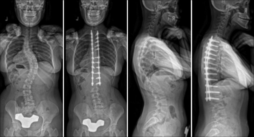 Commonly-Performed-Scoliosis-Surgeries-2BN