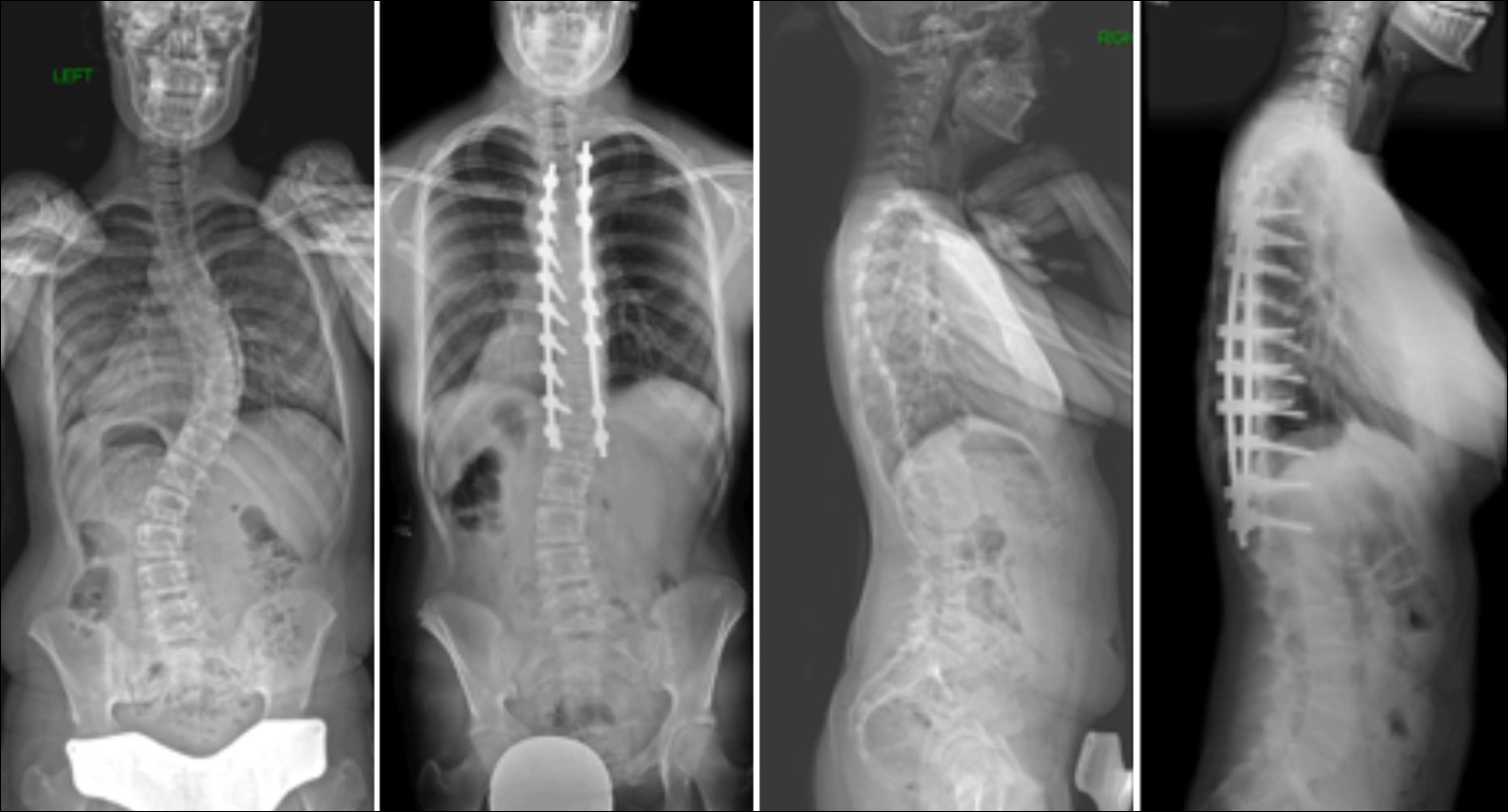 Commonly Performed Scoliosis Surgeries Before & After—2CN - Michael G ...