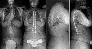 Commonly-Performed-Scoliosis-Surgeries-3A+