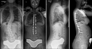 Commonly-Performed-Scoliosis-Surgeries-6CN