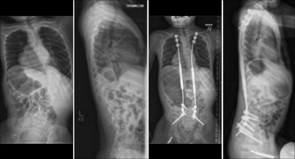 Commonly-Performed-Scoliosis-Surgeries-MAGEC-Rib-Hook-Pelvic-Fixation