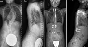 Commonly-Performed-Scoliosis-Surgeries-MAGEC-Screw