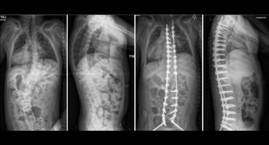 Commonly-Performed-Scoliosis-Surgeries-Neuromuscular-Scoliosis