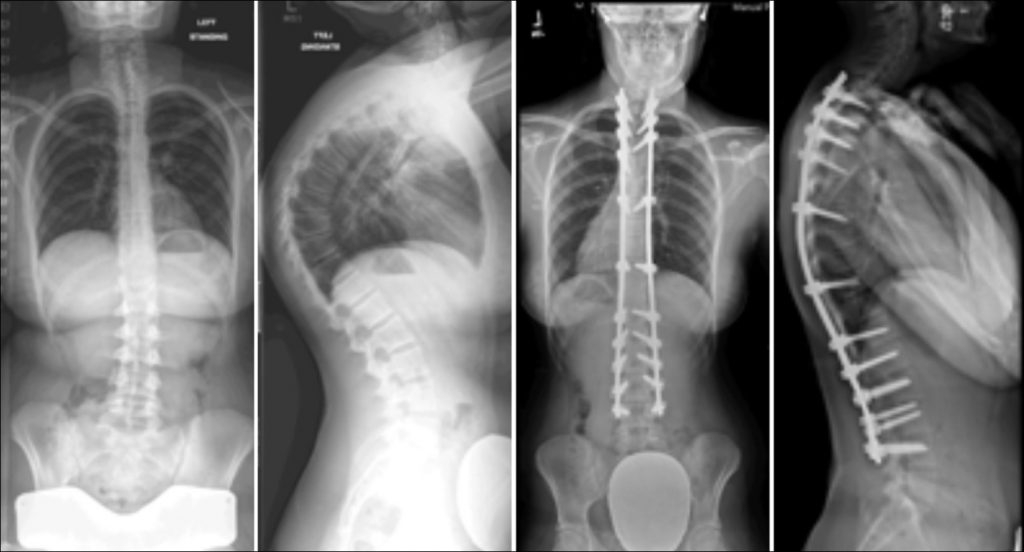 Commonly-Performed-Scoliosis-Surgeries-Scheuermann's-Kyphosis-AT
