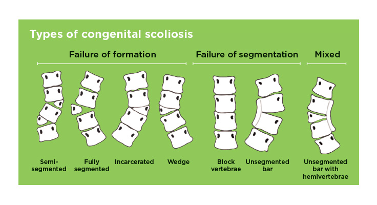 Congenital Scoliosis Types Picture-Diagram