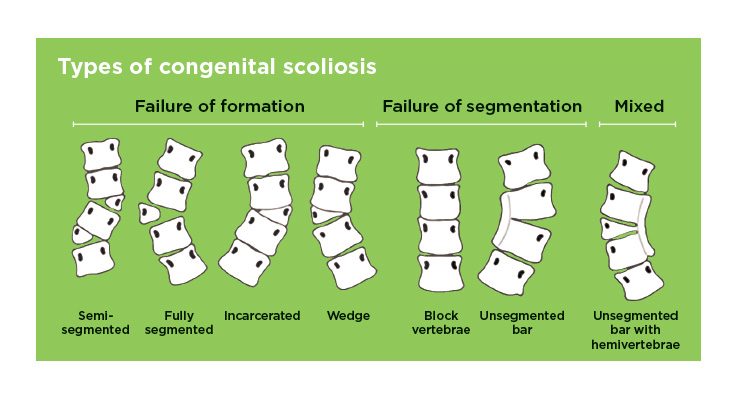 scoliosis types