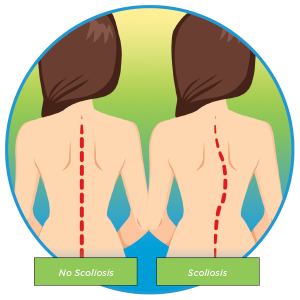 Scoliosis in children illustration