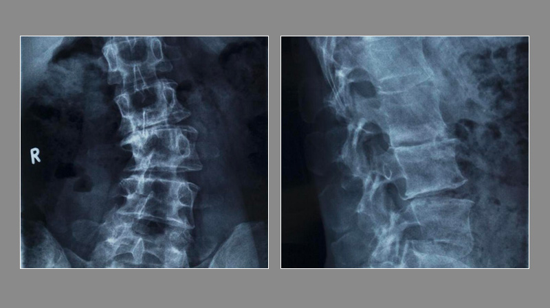 Facts about Scoliosis