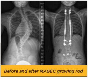 MAGEC-Growing Rods-Before and After