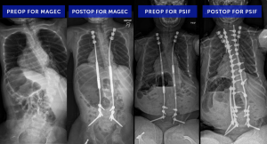 Neuromuscular Scoliosis Case