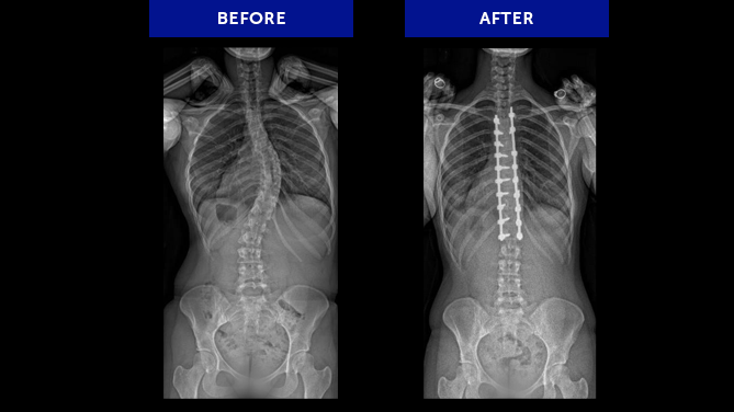 Anonymous 1 | Adolescent Idiopathic Scoliosis