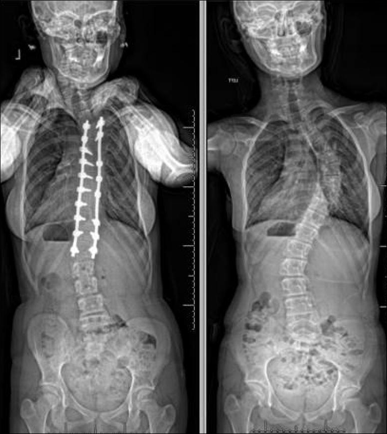 Before and After Spine X-Rays