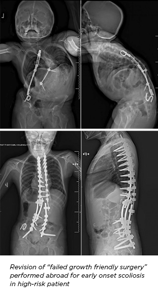 revision-surgery-early-onset-scoliosis