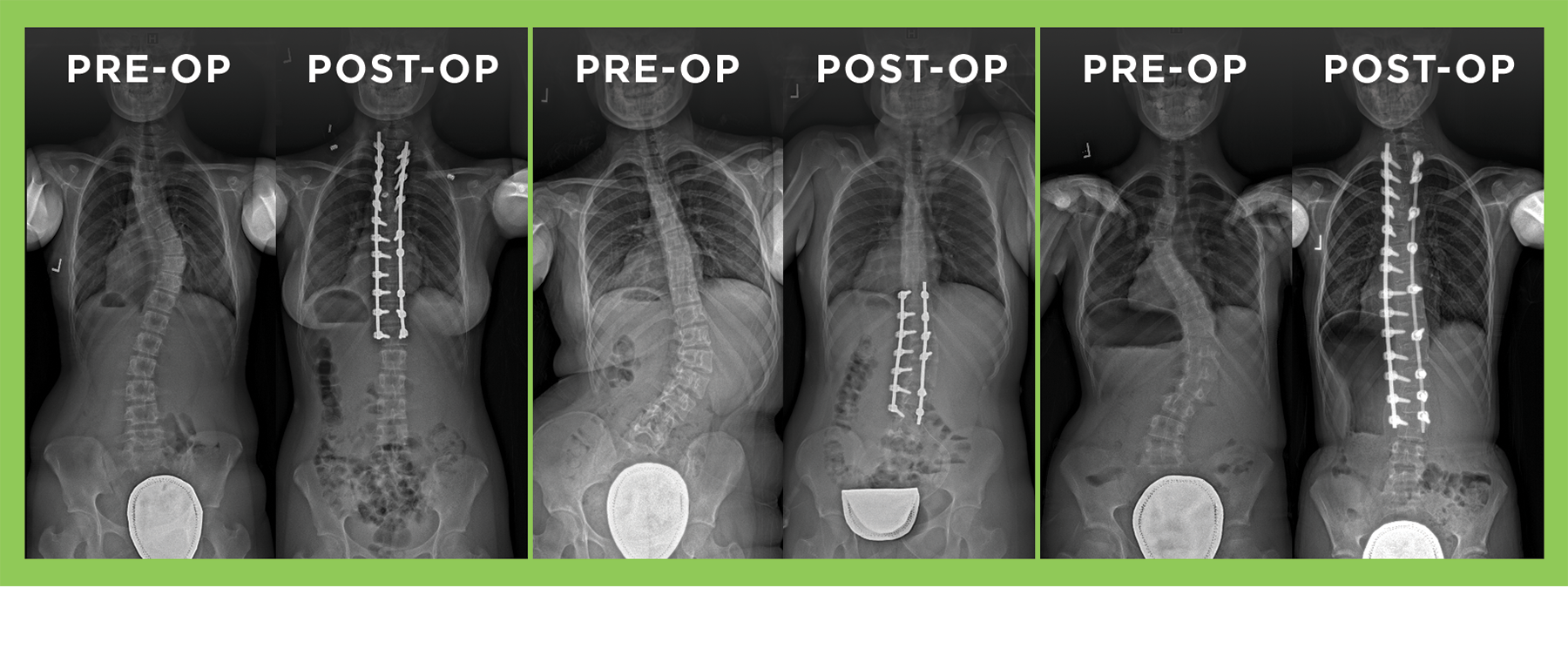 Spinal fusion and instrumentation