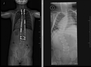 Angela - preop / postop spine x-rays