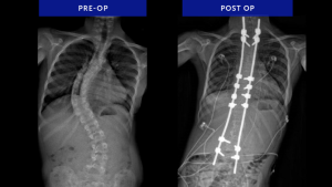 Syndromic Scoliosis Case
