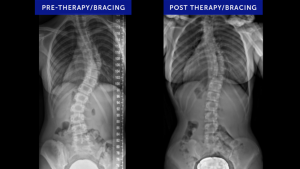 Schroth Physical Therapy and Bracing Scoliosis Case