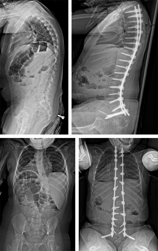 advances-peds-ortho-spine-scans