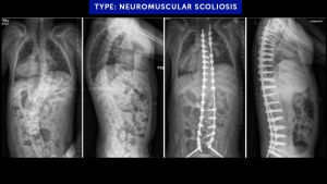 Cases-Featured-3-2023-Type-Neuromuscular-Scoliosis
