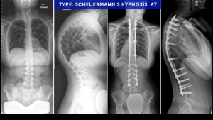 Cases-Featured-3-2023-Type-Scheuermanns-Kyphosis