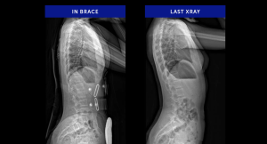 Cases-xrays-AIS-Lateral