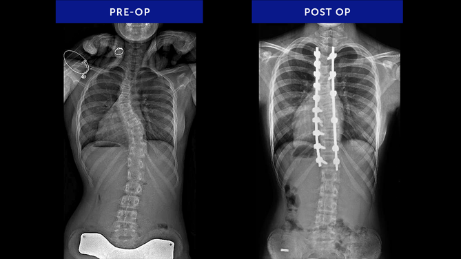 Isabella D. | Adolescent Idiopathic Scoliosis