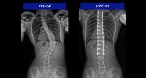Margaret - posterior spinal fusion and instrumentation