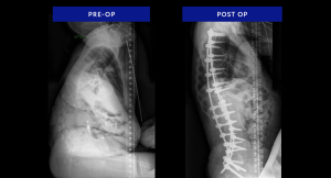 Cases-xrays-Omari-Neuromuscular scoliosis-11-2023-Lateral