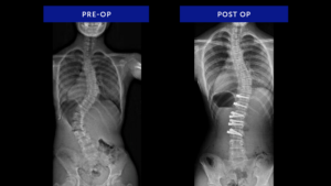 Neuromuscular-Scoliosis
