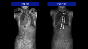 Syndromic-Scoliosis