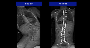 Neuromuscular-Scoliosis