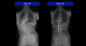 Syndromic-Scoliosis