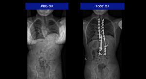 neuromuscular-scoliosis