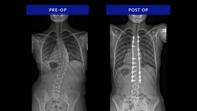 Emma T. | Adolescent Idiopathic Scoliosis