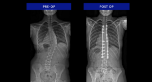 Adolescent Idiopathic Scoliosis Patient