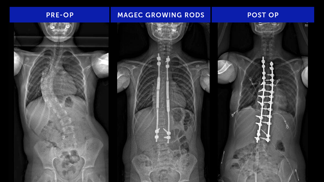 Aidyn C. | Neuromuscular Scoliosis
