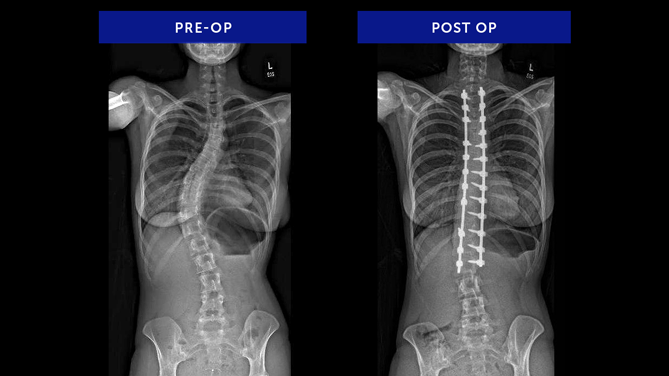 Alexa S. | Adolescent Idiopathic Scoliosis