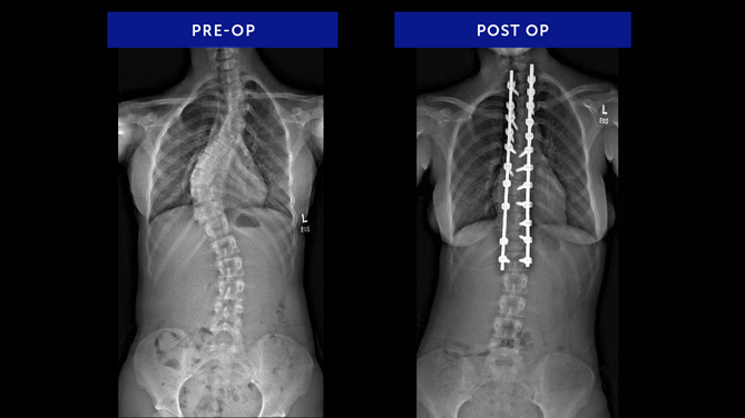 Anonymous 19 | Adolescent Idiopathic Scoliosis