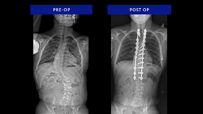 Benjamin G. | Syndromic Scoliosis