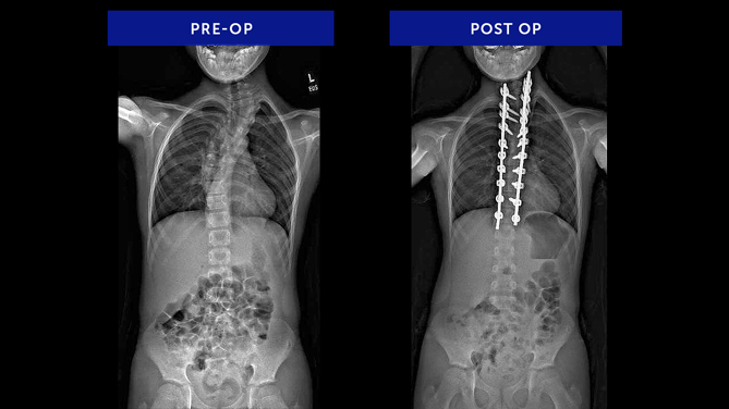 Anonymous 20 | Congenital Scoliosis