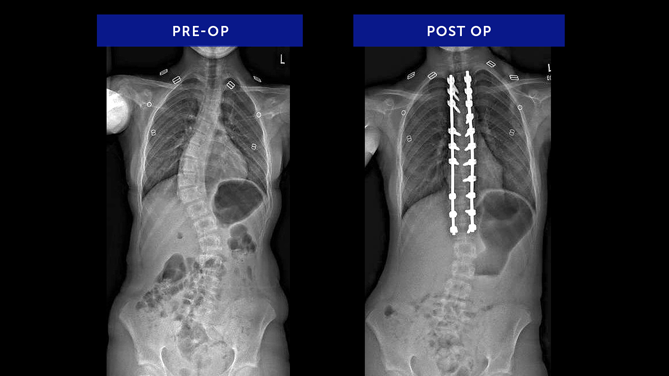 Ellie W. | Adolescent Idiopathic Scoliosis