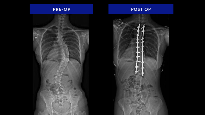Gloria | Adolescent Idiopathic Scoliosis