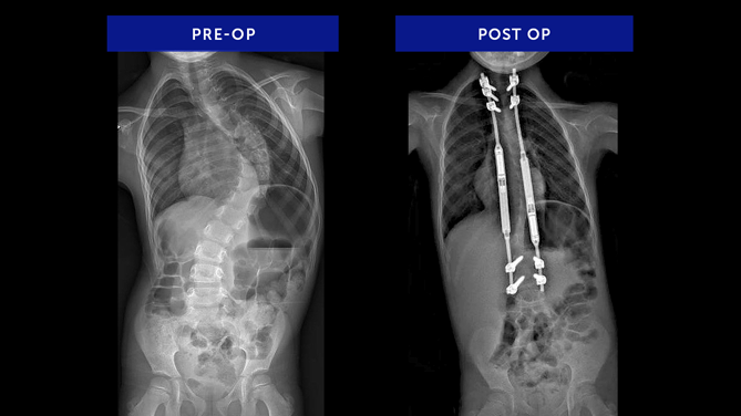 Ava R. | Infantile Idiopathic Scoliosis