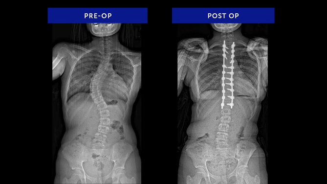 Serenity G. | Adolescent Idiopathic Scoliosis
