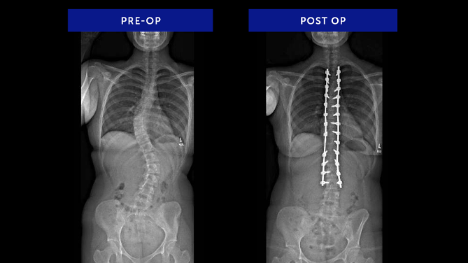 Skylar M. | Adolescent Idiopathic Scoliosis